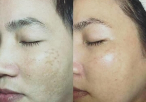 Điều trị nám tàn nhang bằng Laser Toning